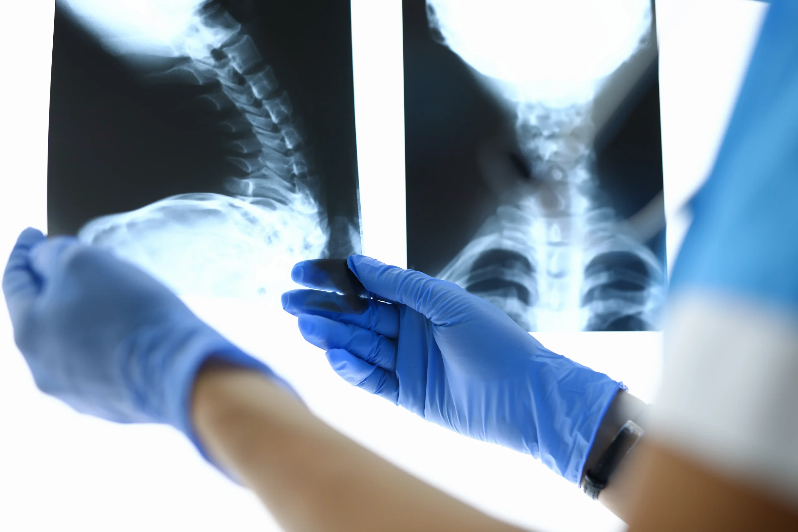 Spinal Cord Injuries